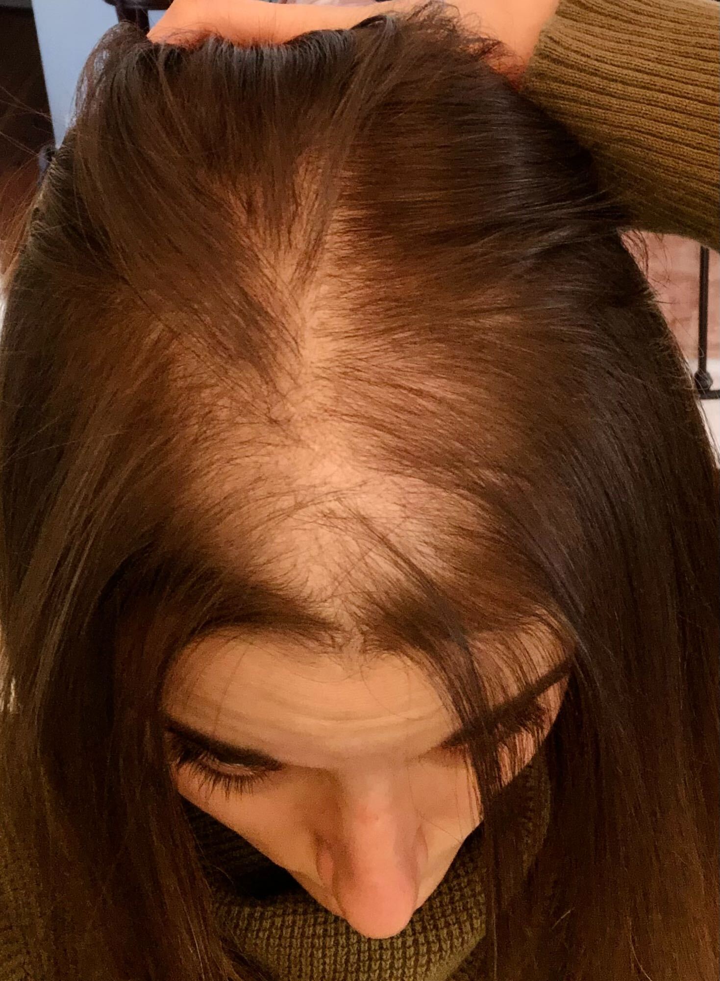 Cristina Marie losing her hair